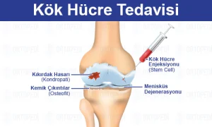 Kök Hücre Tedavisi