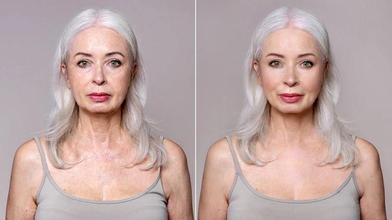 Yüz Germe (Face Lift) Operasyonları: Gençleşmenin Sırrı 1