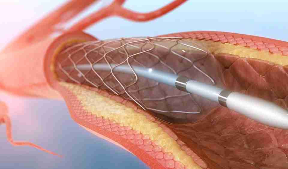 Türkiye’de Anjiyo ve Stent Uygulamaları (2025): Kalp Sağlığınız Güvende