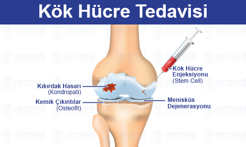 Kök Hücre Tedavisi