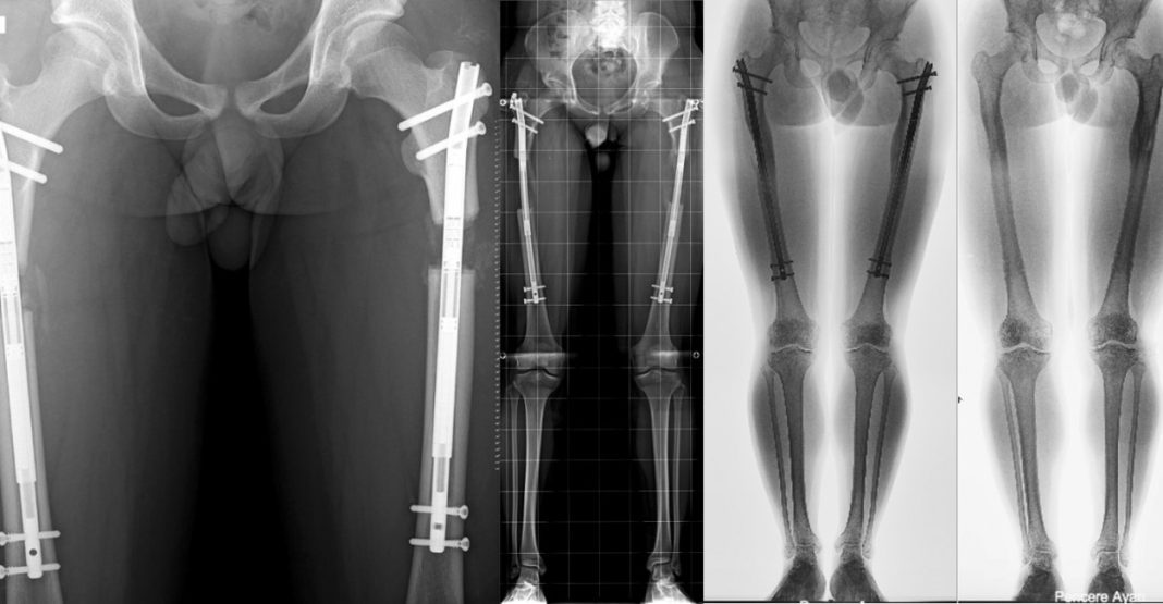 Boy Uzatma Ameliyatı Türkiye: 5 Farklı Teknik, Maliyetler ve Süreç Detayları