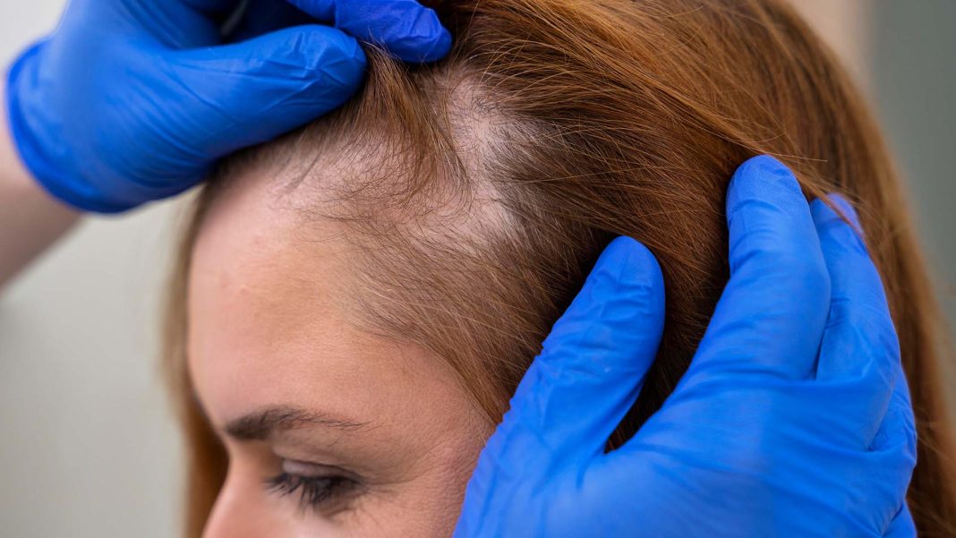 Türkiye’de Anti-Hair Loss Tedavileri: 2025’te Saç Dökülmesine Karşı Klinik Çözümler